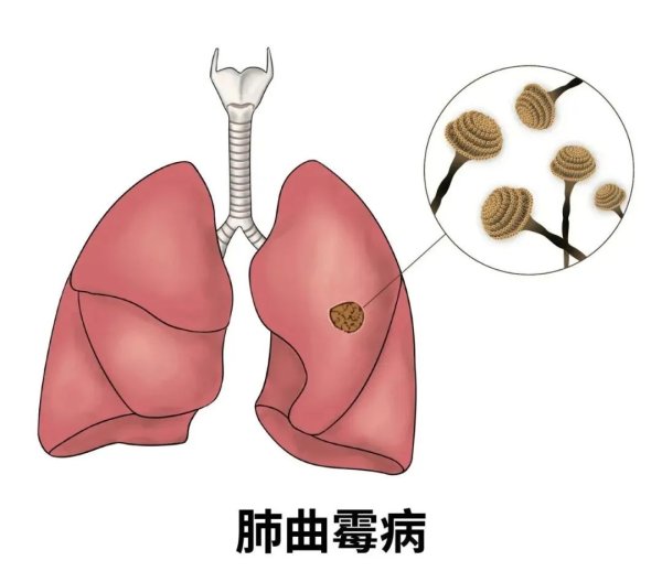 天宇优配  女子家中中招致肺部“发霉”，快检查你家可能也有→